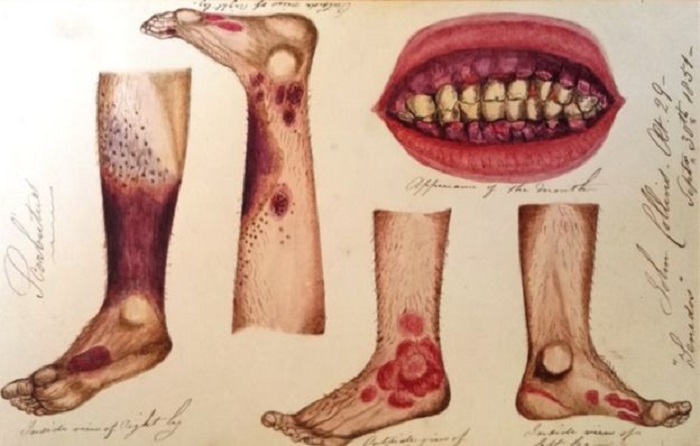 Symptoms of the scurvy disease.