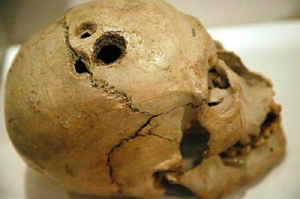 A pierced skull, approximately 4000 years old.