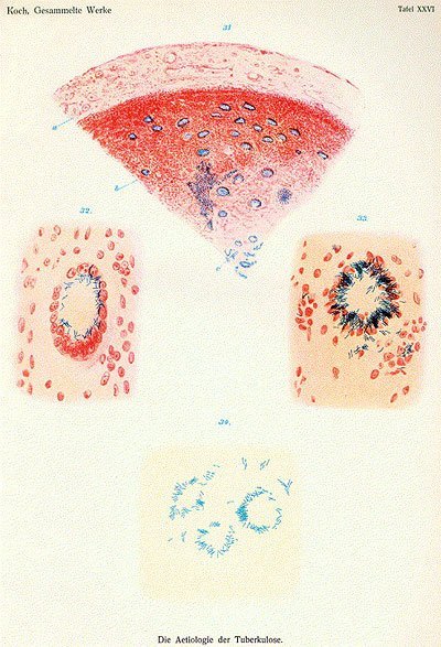 A page from Robert Koch's "Etiology of Tuberculosis" (1884). Koch's stain for tuberculosis bacteria is blue, but the current standard stain is red.