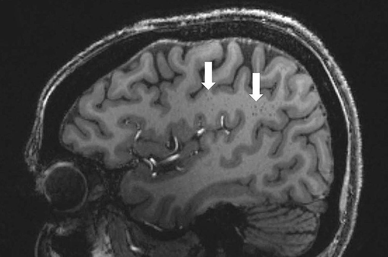 How Migraines Change the Brain