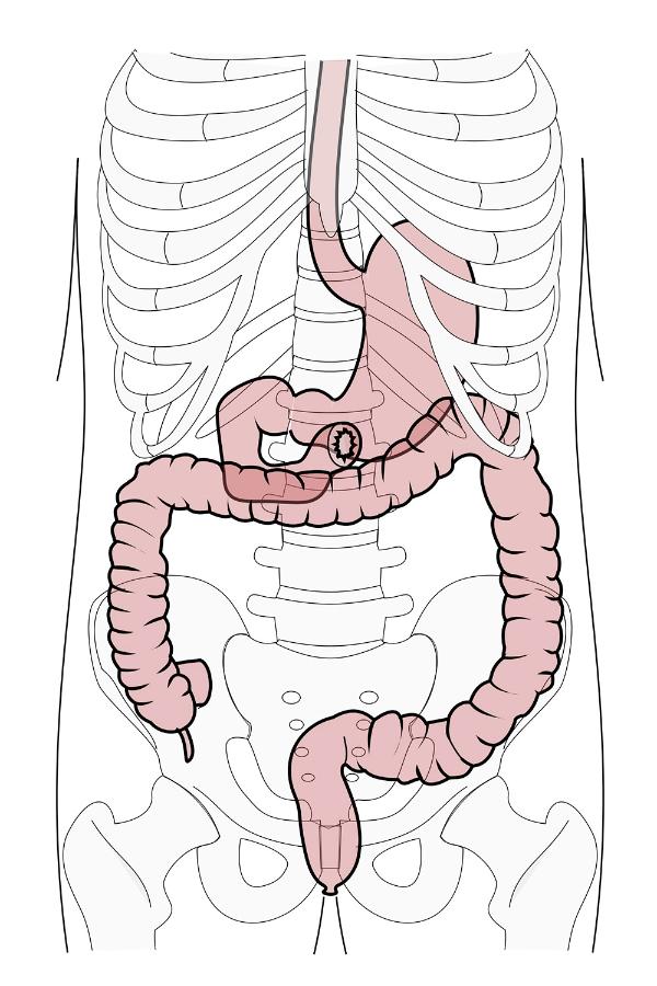 The narrow appendix (bottom left) hangs on the appendix and is prone to inflammation