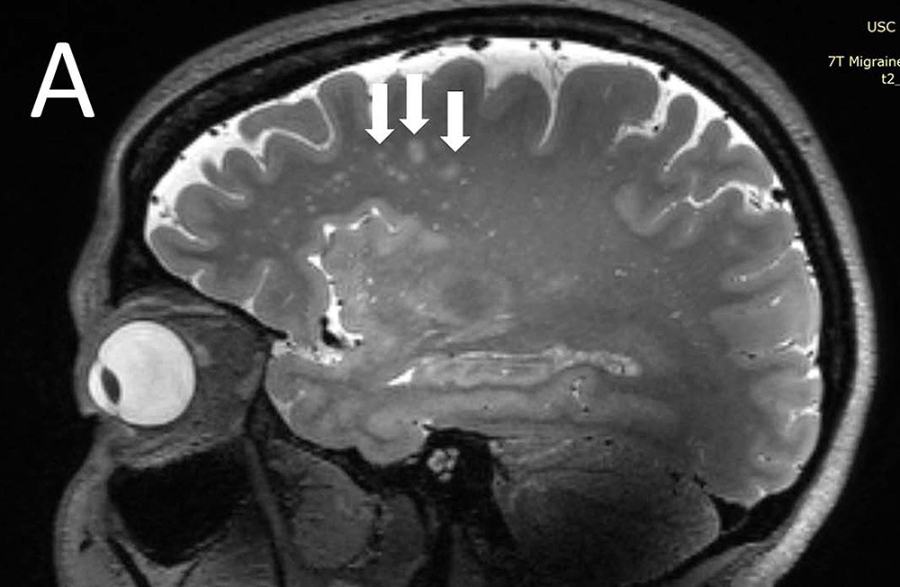 Regional white matter compression was also more common in migraine sufferers. 