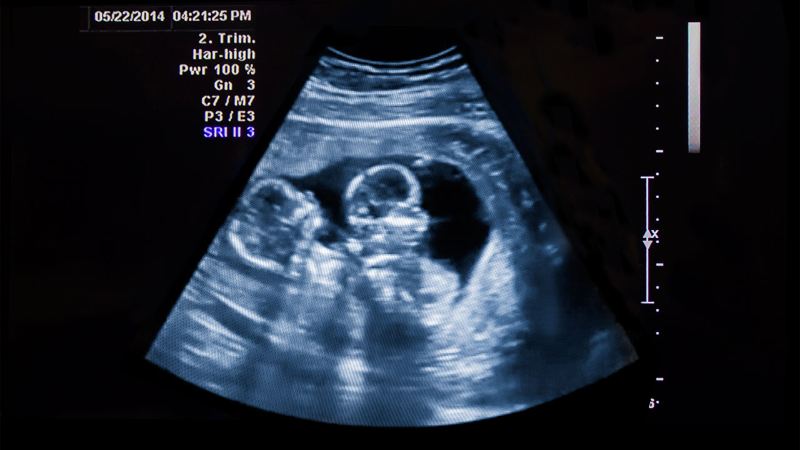 Nowadays, more and more twins are being born