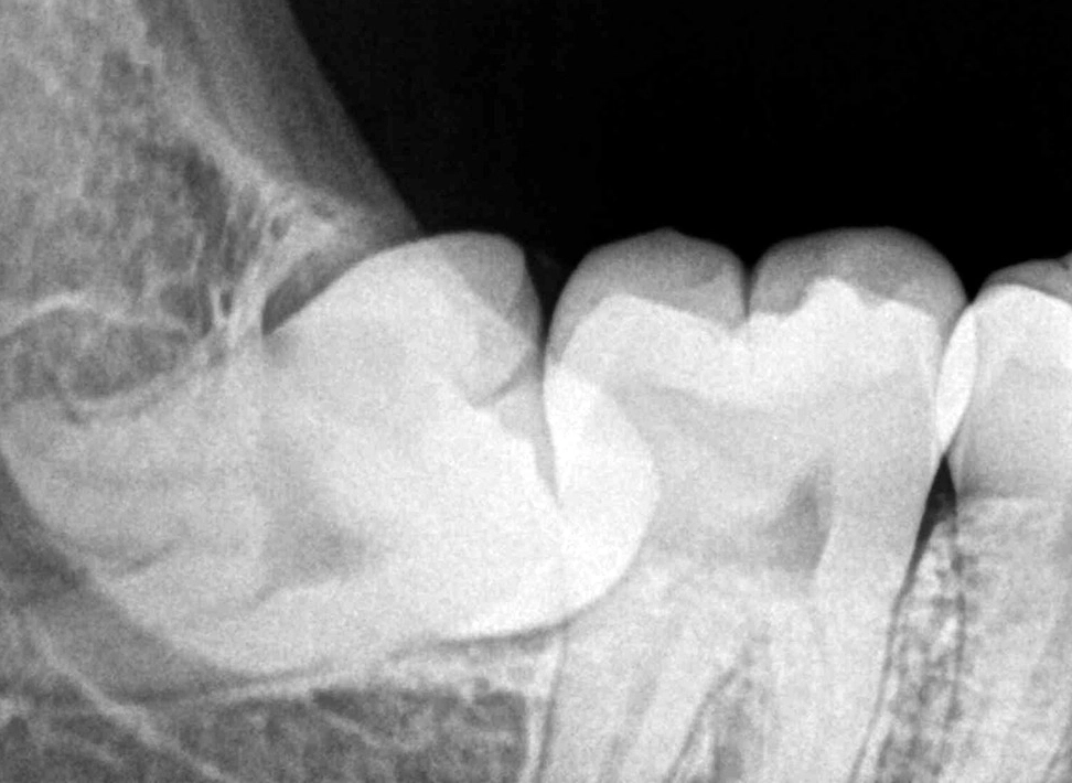 When wisdom teeth break crooked through the gums, they can damage other teeth