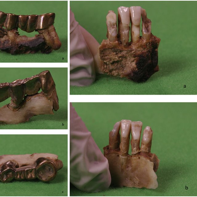 Dental crowns, bridges, and teeth purportedly of Adolf Hitler. 