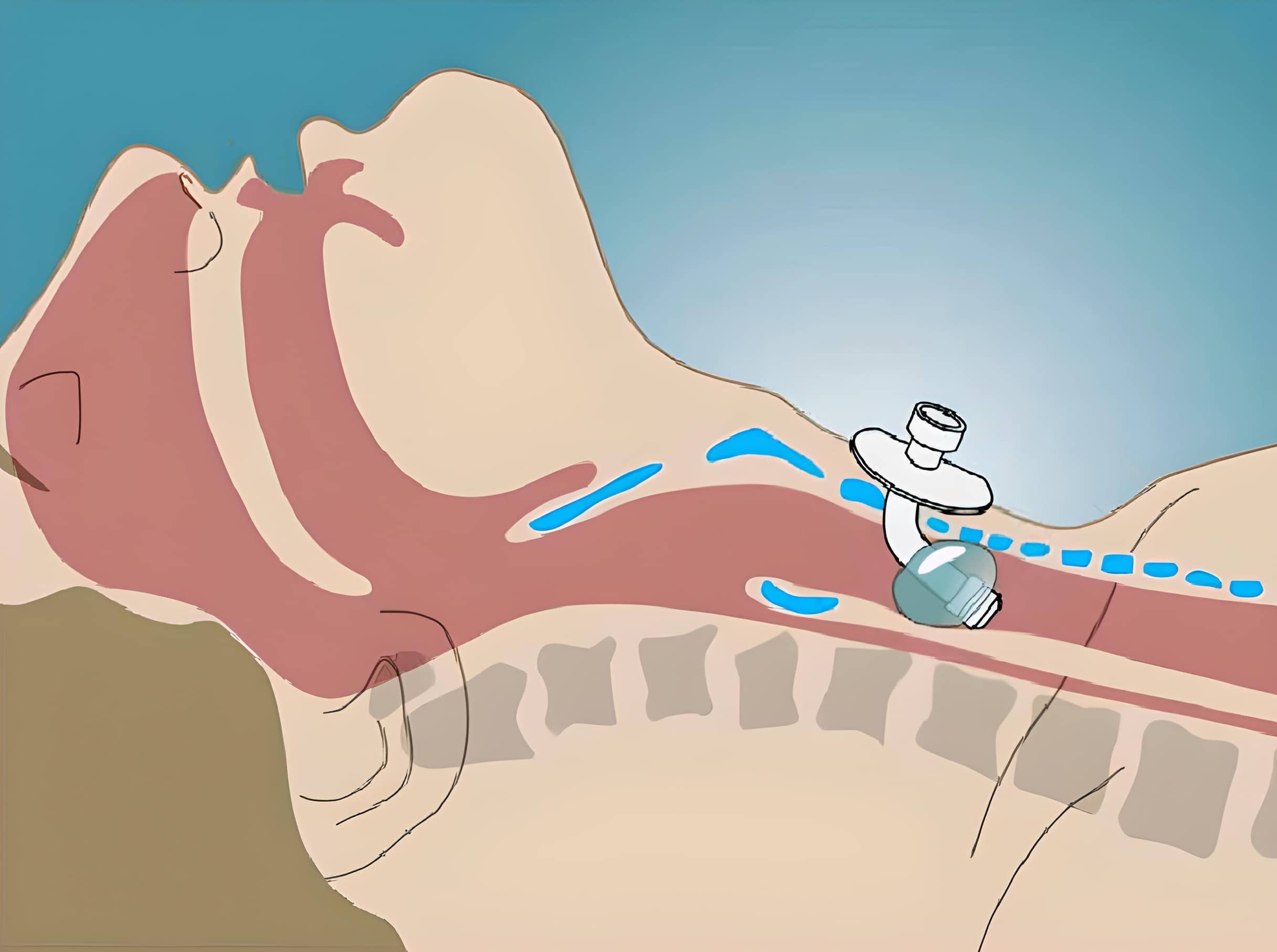 tracheostomy tube