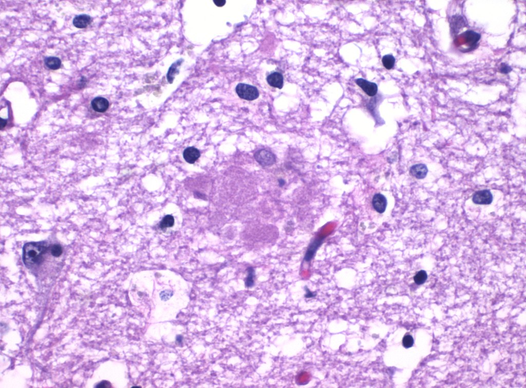 Histopathology of amyloid plaque in Alzheimer's disease.