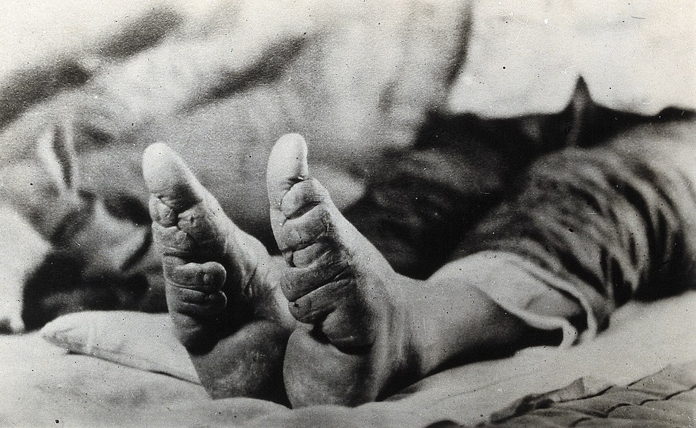 Feet of a Chinese woman, showing the effect of footbinding