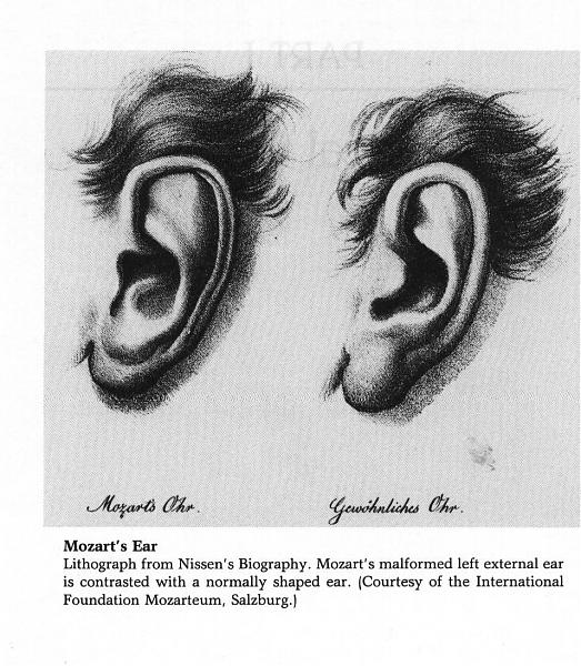 Representation of Mozart's left ear (left) and a normal ear (right)